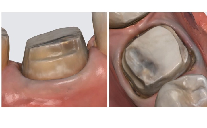 Vertical preparation protocols: The complete guide in 24 lessons from Tomorrow Tooth