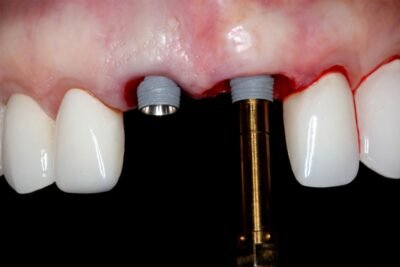 Online Residency Program: A-Z in Implant Dentistry