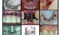 A-Z in Restorative Implant Dentistry Series
