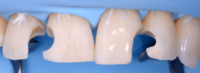 Direct and Indirect Adhesive Restorations