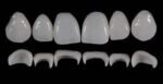 Prosthetic Rehabilitation on Natural Teeth – Predictable, Esthetic and Systematic Steps