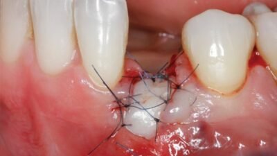 Soft Tissue Management around Natural Teeth and Dental Implants