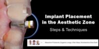 Implant Placement in the Aesthetic Zone: Steps and Technique