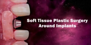 Soft Tissue Plastic Surgery Around Implants