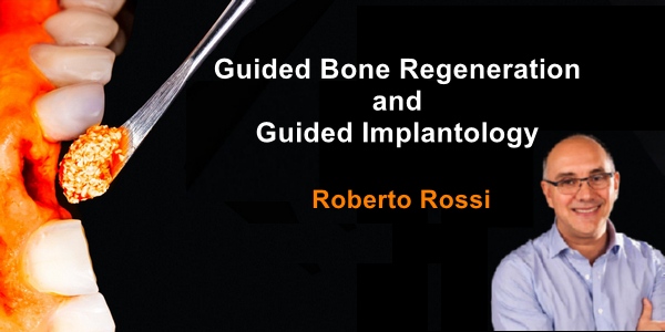 Guided Bone Regeneration and Guided Implantology - Online Dental Library