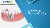 Vertical & Horizontal Bone Grafts (238 Lectues Collection)