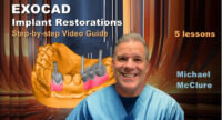 EXOCAD Implant Restorations: Step-by-step Video Guide EXOCAD Implant Restorations: Step-by-step Video Guide
