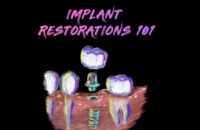 Implant Restorations 101 Implant Restorations 101