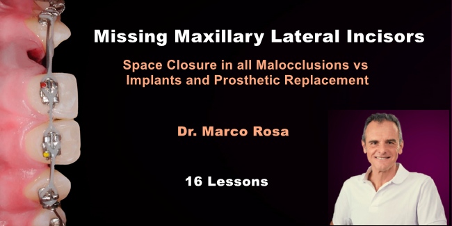 Missing Maxillary Lateral Incisors: Space Closure in all Malocclusions ...