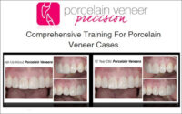 Porcelain Veneer Precision: Comprehensive Training for Porcelain Veneer Cases Porcelain Veneer Precision: Comprehensive Training for Porcelain Veneer Cases