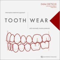 Tooth Wear Interceptive Treatment Approach with Minimally Invasive Protocols