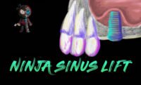 Ninja Sinus Lift Course