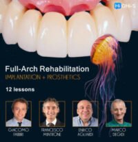Full-Arch Rehabilitation: Implantation and Prosthetics