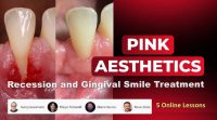 Pink Aesthetics: Recession and Gingival Smile Treatment Pink Aesthetics: Recession and Gingival Smile Treatment