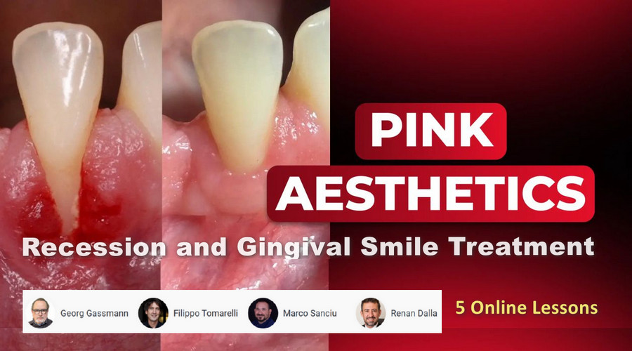 Pink Aesthetics: Recession and Gingival Smile Treatment Pink Aesthetics: Recession and Gingival Smile Treatment