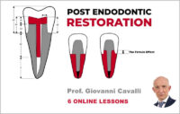 Post Endodontic Restoration: From Root Canal Preparation to Occlusal Check Post Endodontic Restoration: From Root Canal Preparation to Occlusal Check